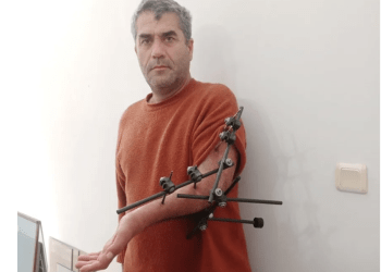 Kazada kopan kolunu kurtardığına sevinemedi