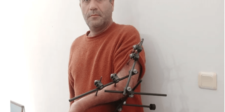 Kazada kopan kolunu kurtardığına sevinemedi