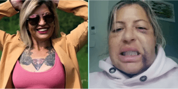 Gülüşünü değiştirmek için Türkiye’de estetik oldu bu hale geldi