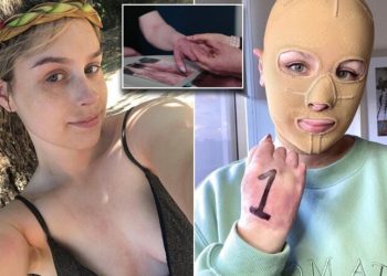 Hayatı saniyeler içinde değişti: Artık sürekli maske takmak zorunda