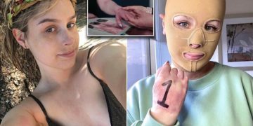 Hayatı saniyeler içinde değişti: Artık sürekli maske takmak zorunda