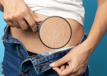 Doğum Çatlaklarından nasıl kurtulabilirsiniz?