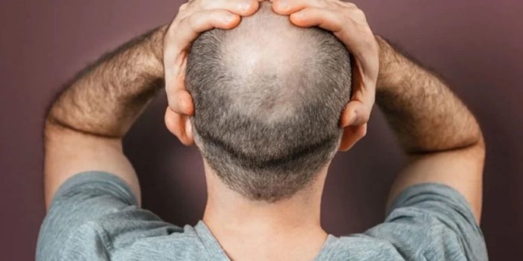 Kelleri sevindiren protein tedavisi: Saç ekimi tarihe karışacak