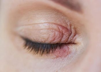 Kirpiklerinizde yaşayan sekiz bacaklı akarlar görme yetinizi bozabilir