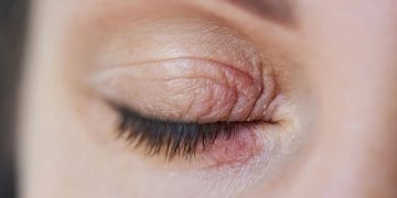 Kirpiklerinizde yaşayan sekiz bacaklı akarlar görme yetinizi bozabilir