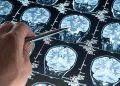 Bilim dünyası şokta: En genç Alzheimer vakası teşhis edildi