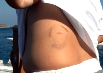 Bodrum’da saldırgan caretta kabusu başladı 6 kişi yaralandı