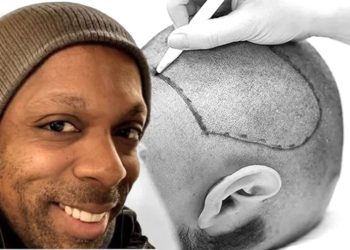 İstanbul’da yaptırdığı saç ekimi sonu oldu