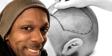 İstanbul’da yaptırdığı saç ekimi sonu oldu