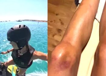 Çağla Şıkel’in bacakları mosmor oldu