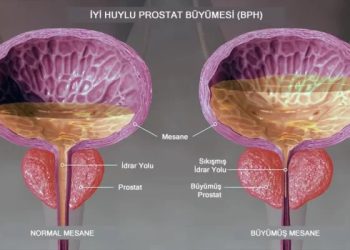 İYİ HUYLU PROSTAT BÜYÜMESİNİN 6 BELİRTİSİ