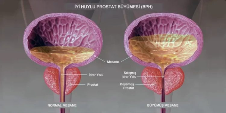 İYİ HUYLU PROSTAT BÜYÜMESİNİN 6 BELİRTİSİ